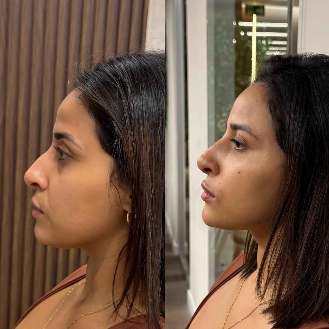 Antes e depois de harmonização facial, perfil