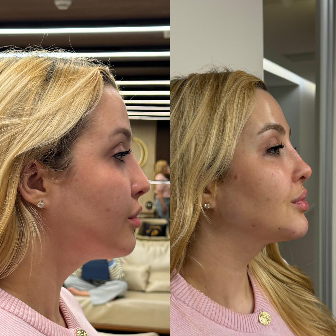 Antes e depois de harmonização facial, perfil