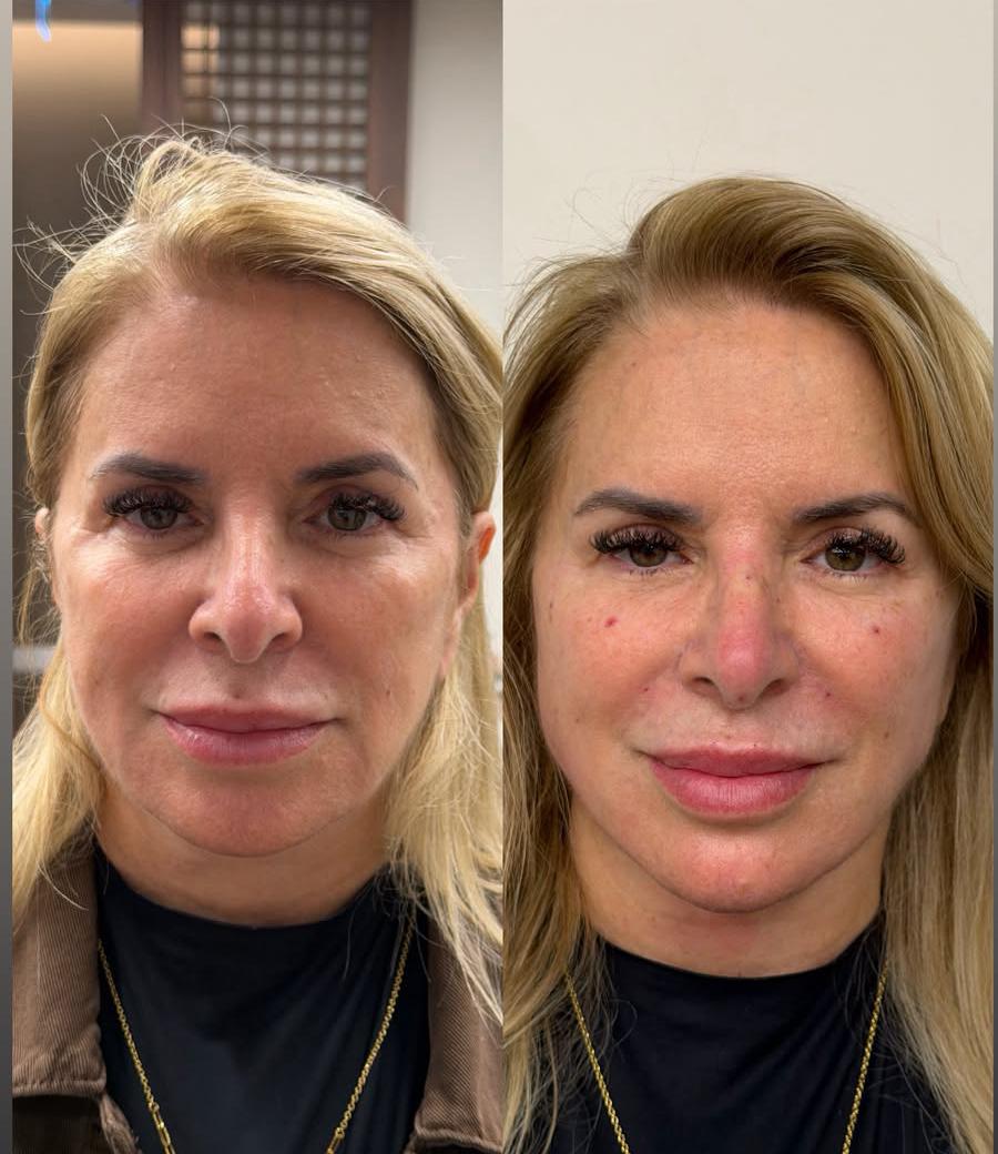 Antes e depois de harmonização facial, vista frontal